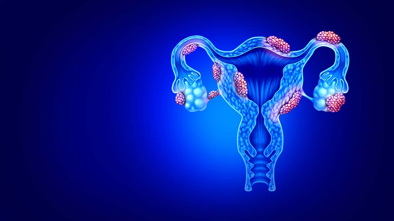 endometriosis-1280x720