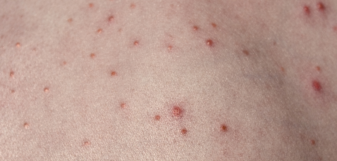 folliculitis_s.jpg