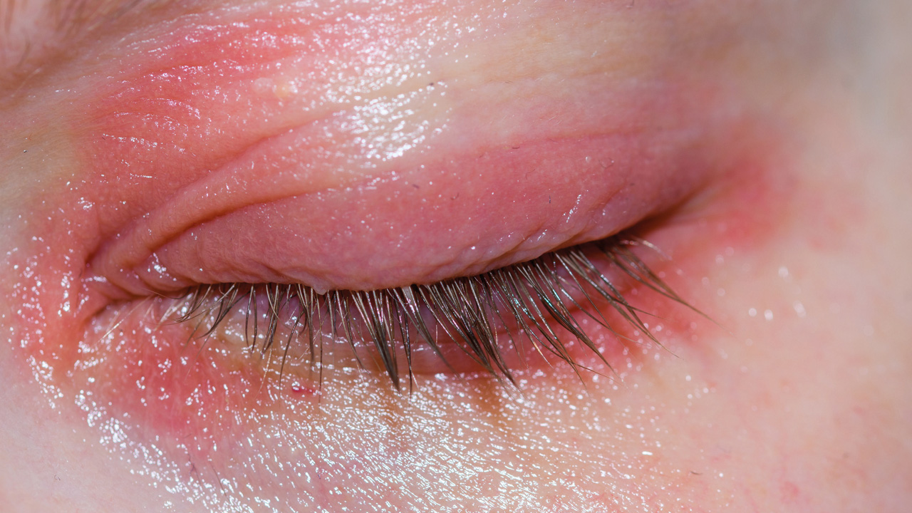 blepharitis